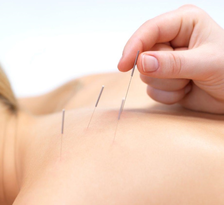 Acupuncture
